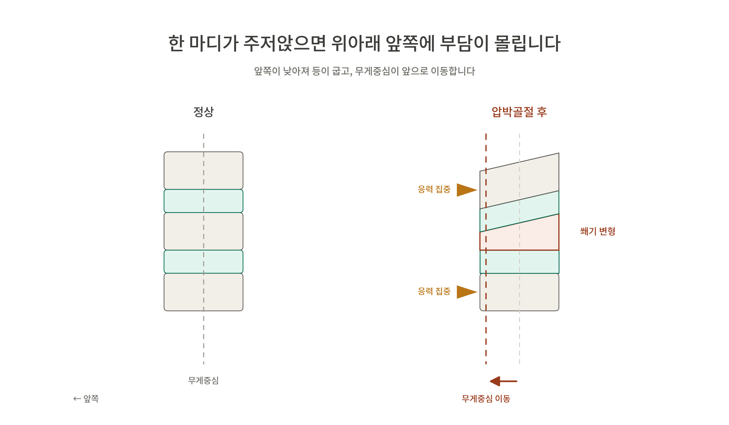 압박 전후의 무게 중심 변화와 그에 따른 응력 집중을 설명하는 다이어그램
